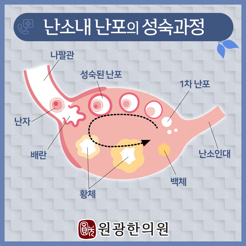 다낭성난소증후군이 생리 주기와 임신에 미치는 영향